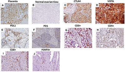 VISTA/CTLA4/PD1 coexpression on tumor cells confers a favorable immune microenvironment and better prognosis in high-grade serous ovarian carcinoma